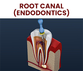 root canal (endodotics) in turkey