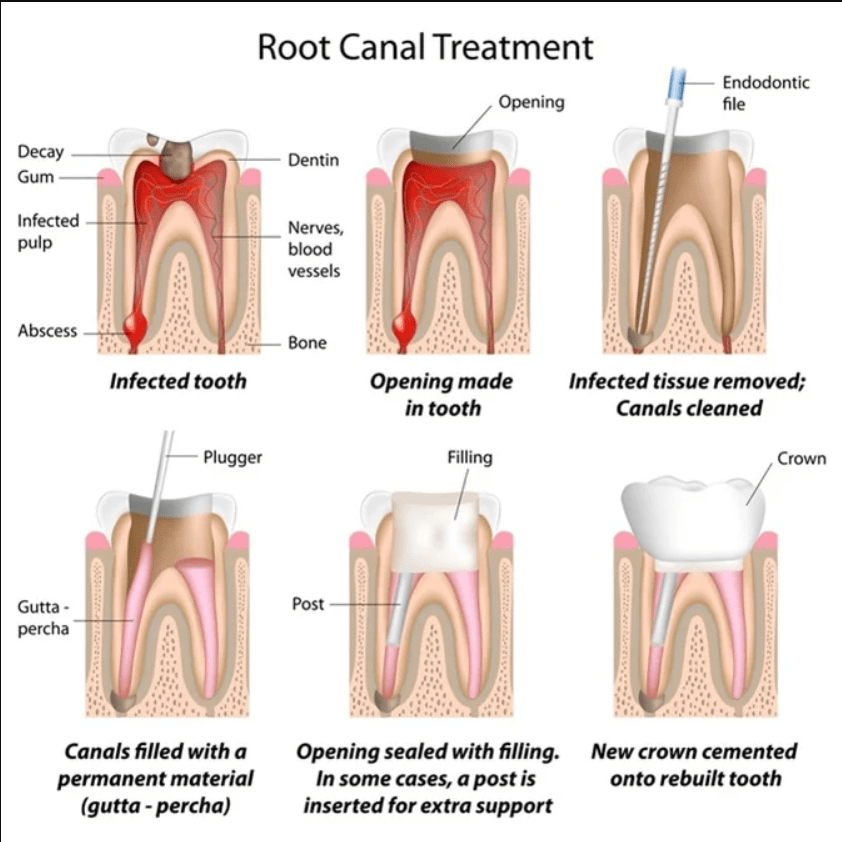 uzmanlar_dental_clinic_root_canal_treatment_process