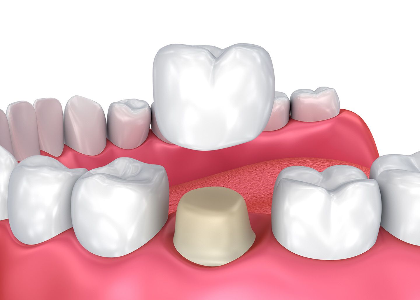 What is a dental crown?