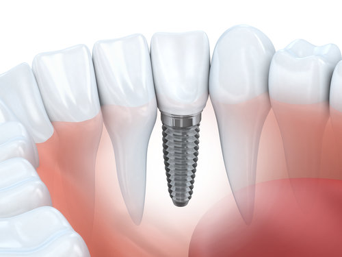 Dental Implant Treatment