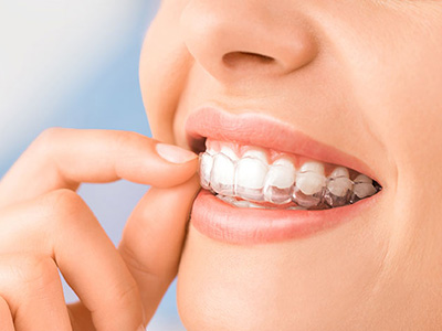 dental-aligner-treatment