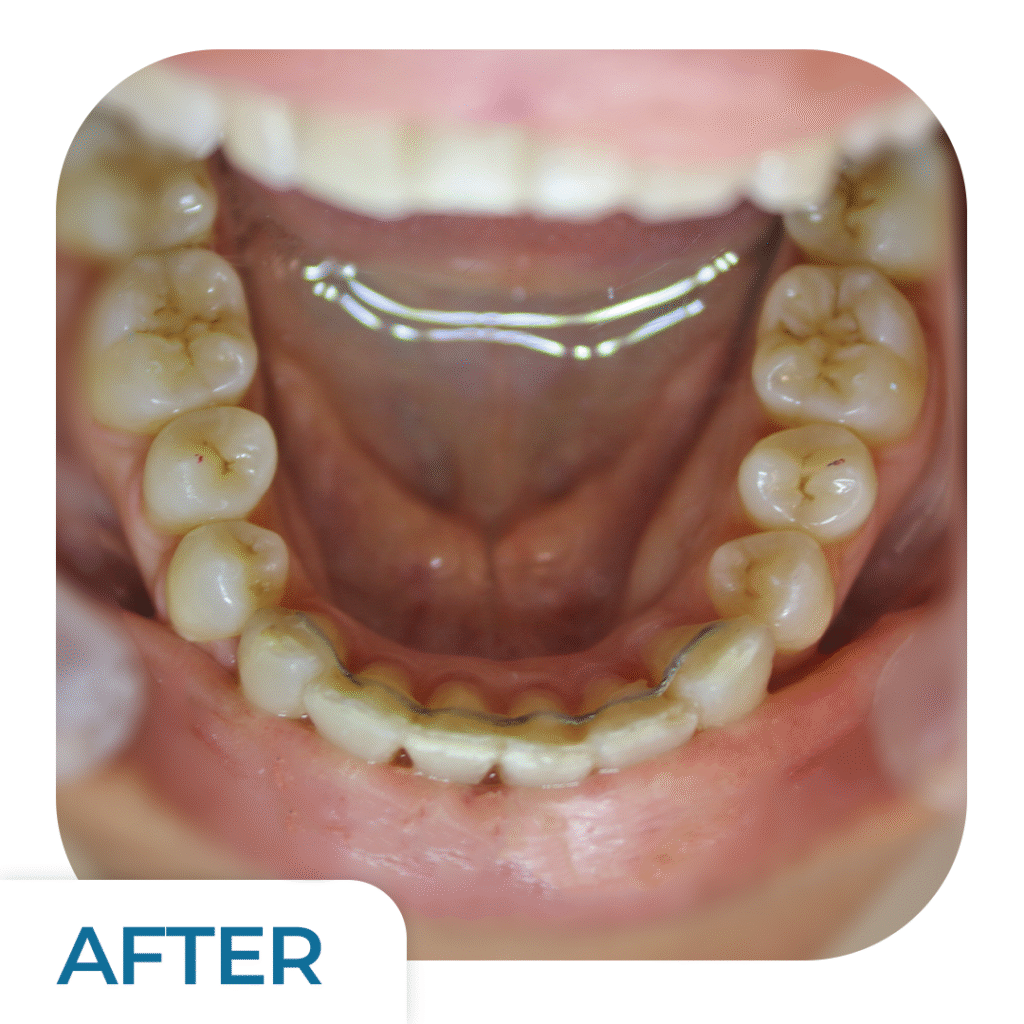 Emax Luminate Treatment | Uzmanlar Dental Clinic Istanbul Turkiye