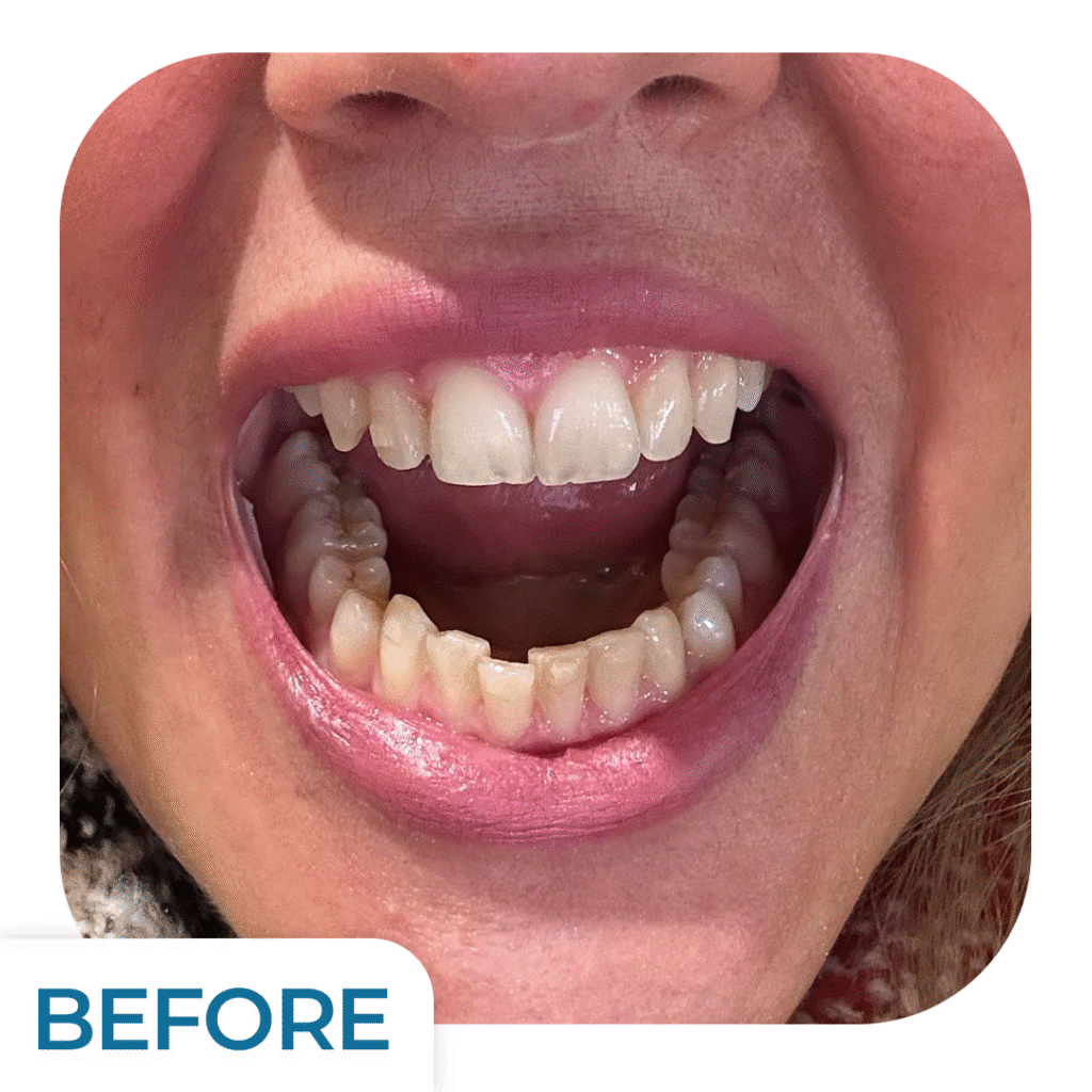 Orthodontics (Aligner) Treatment | Uzmanlar Dental Clinic Istanbul Turkiye