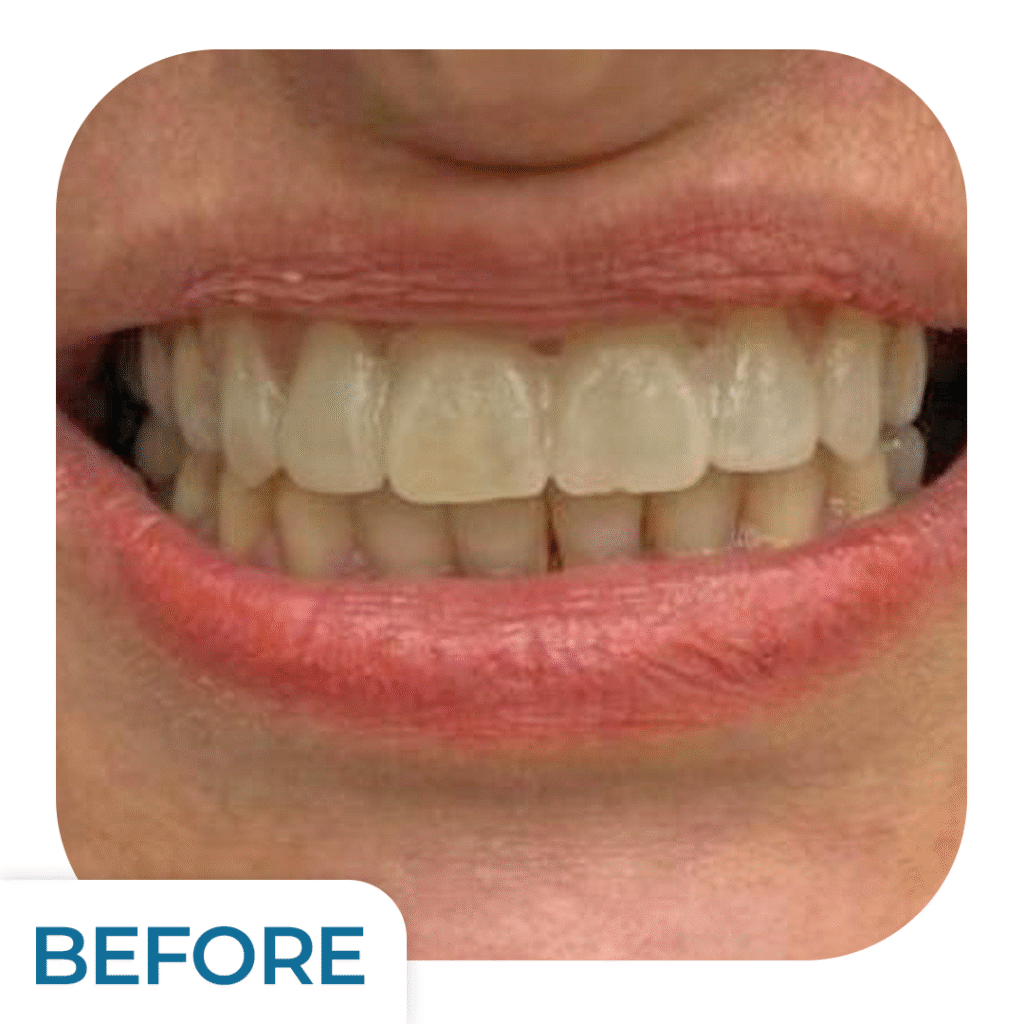 Emax Luminate Treatment | Uzmanlar Dental Clinic Istanbul Turkiye