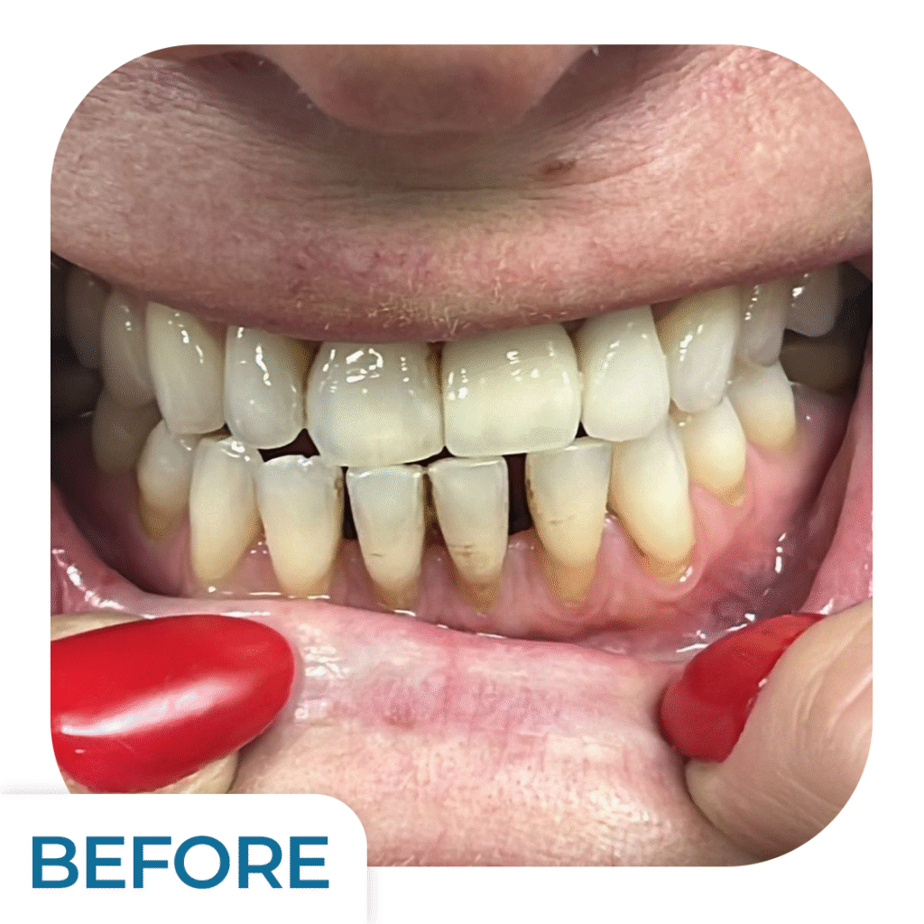 Emax Crown Treatment | Uzmanlar Dental Clinic Istanbul Turkiye