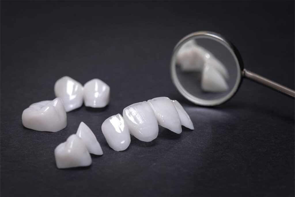 Set of porcelain dental veneers before placement