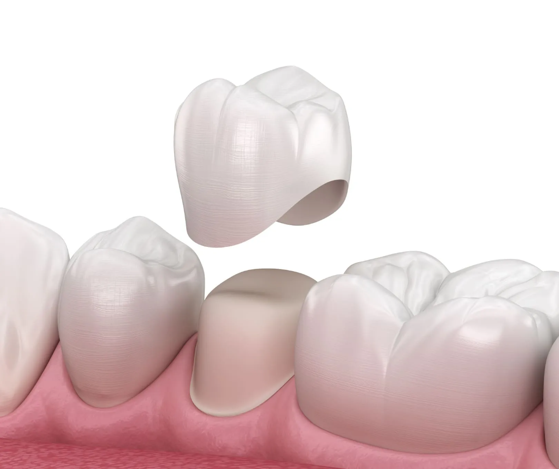 Dental Crown Treatment in Turkey