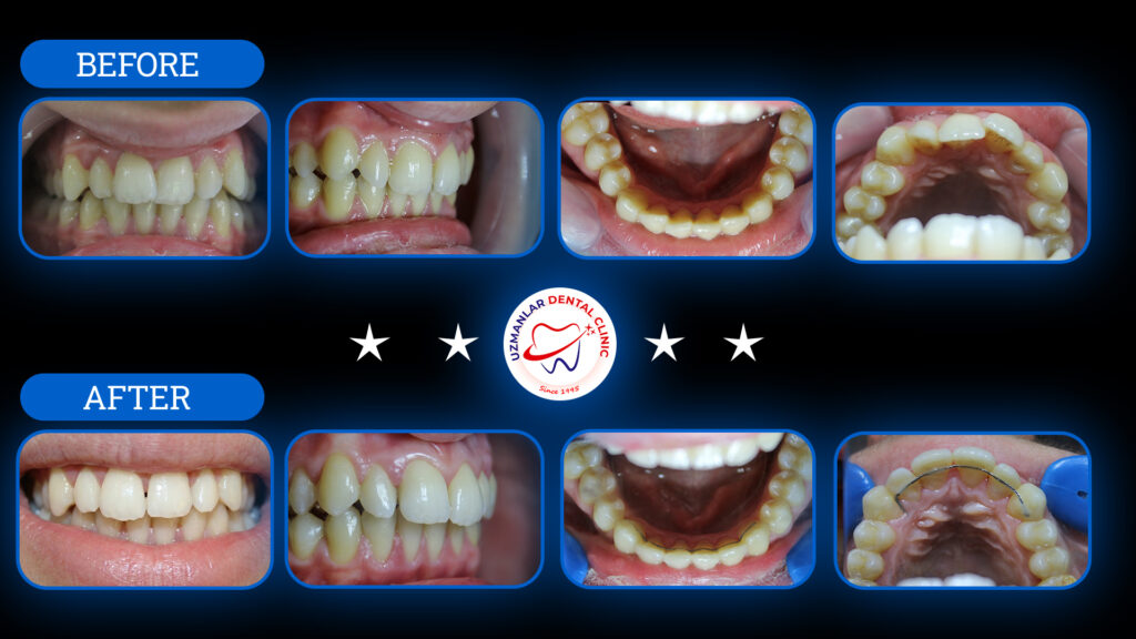 Aligner Treatment Before and After Treatment Images