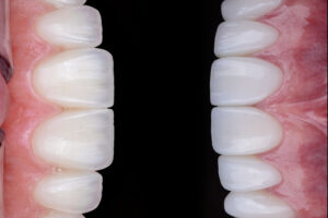 Veneers & Crowns treatment in Istanbul Turkiye