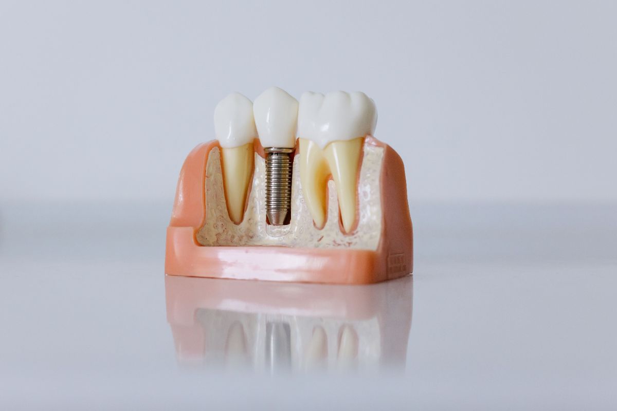 All-on-4 Dental Implants in Turkey: Full-Mouth Restoration in 2026