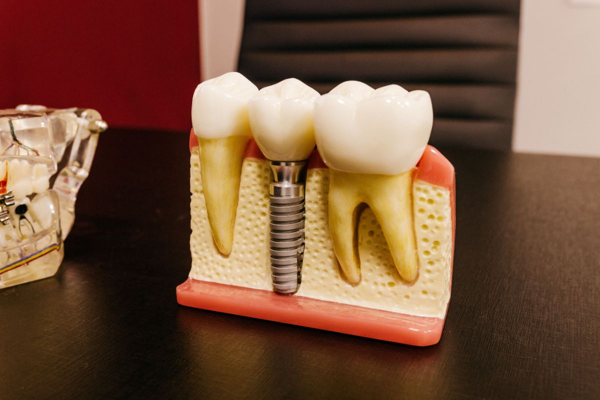 Dental implant screws on a table used for All-on-4 dental implants Turkey treatment