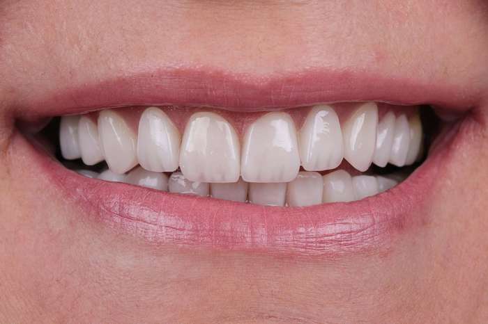 E-max veneer being applied to front teeth during treatment