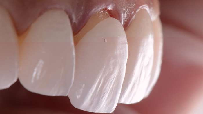 E-max Veneers in Turkey: How Long They Actually Last in 2026