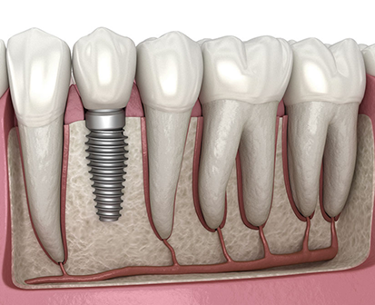 Cross-section of a titanium dental implant replacing a missing molar