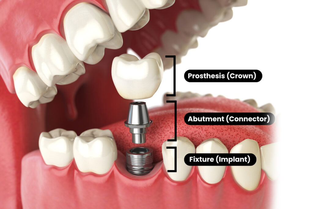 Parts of a dental implant: prosthesis (crown), abutment (connector) and fixture (implant)