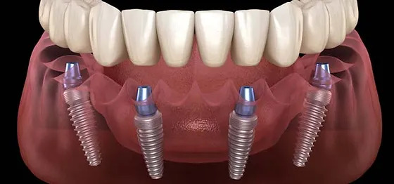 All-on-4 dental implants Istanbul illustration showing four implants supporting a fixed lower arch bridge