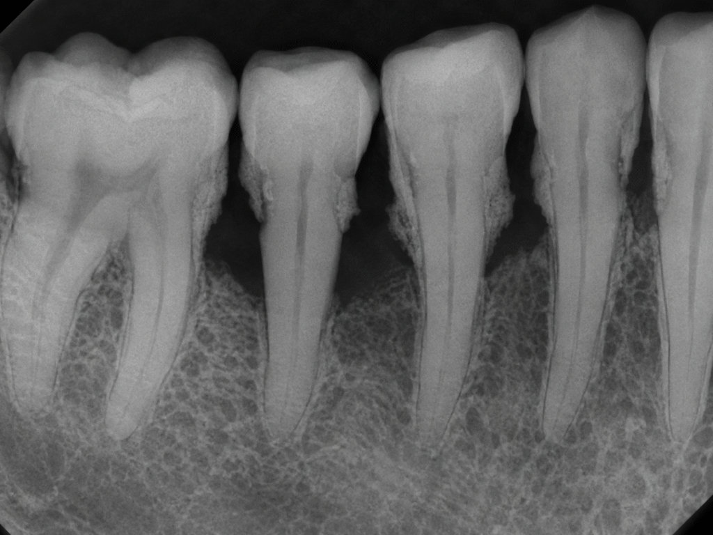 Dental X-ray showing tooth roots and jawbone used to plan All-on-4 implant placement