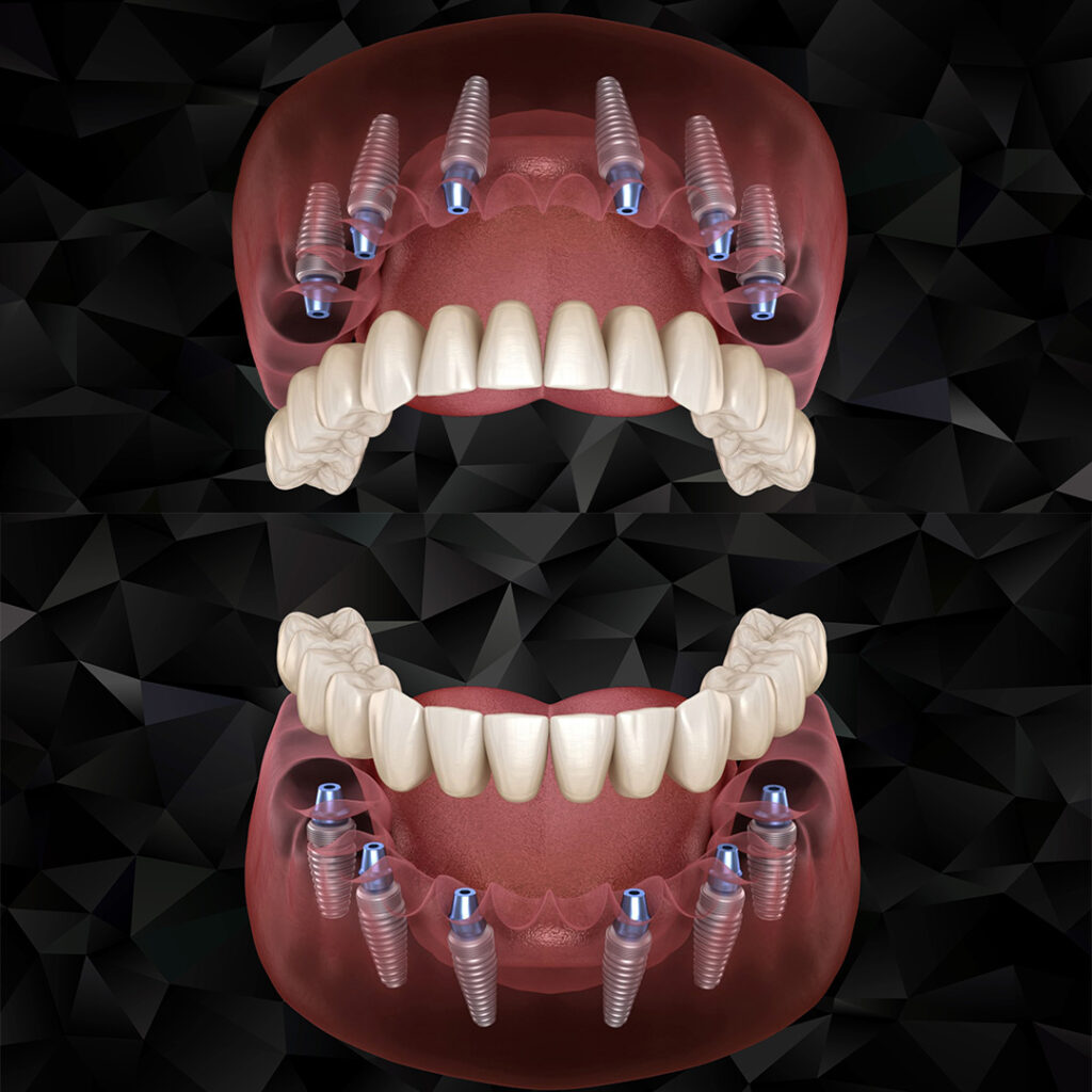 Bottom view illustration of All-on-4 implant supported full arch bridge