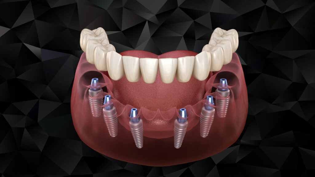 Close-up of dental implant crowns and abutments replacing missing teeth