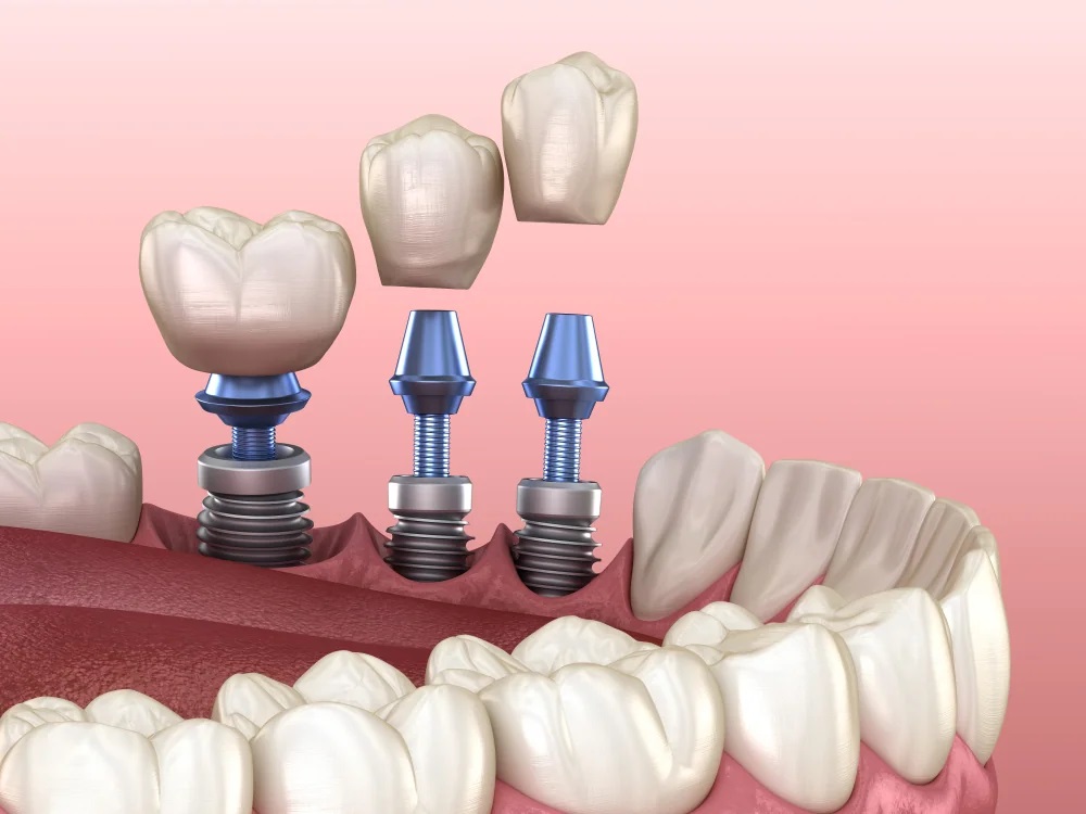 All-on-4 Dental Implants in Istanbul: The Complete Guide to Full-Arch Tooth Replacement