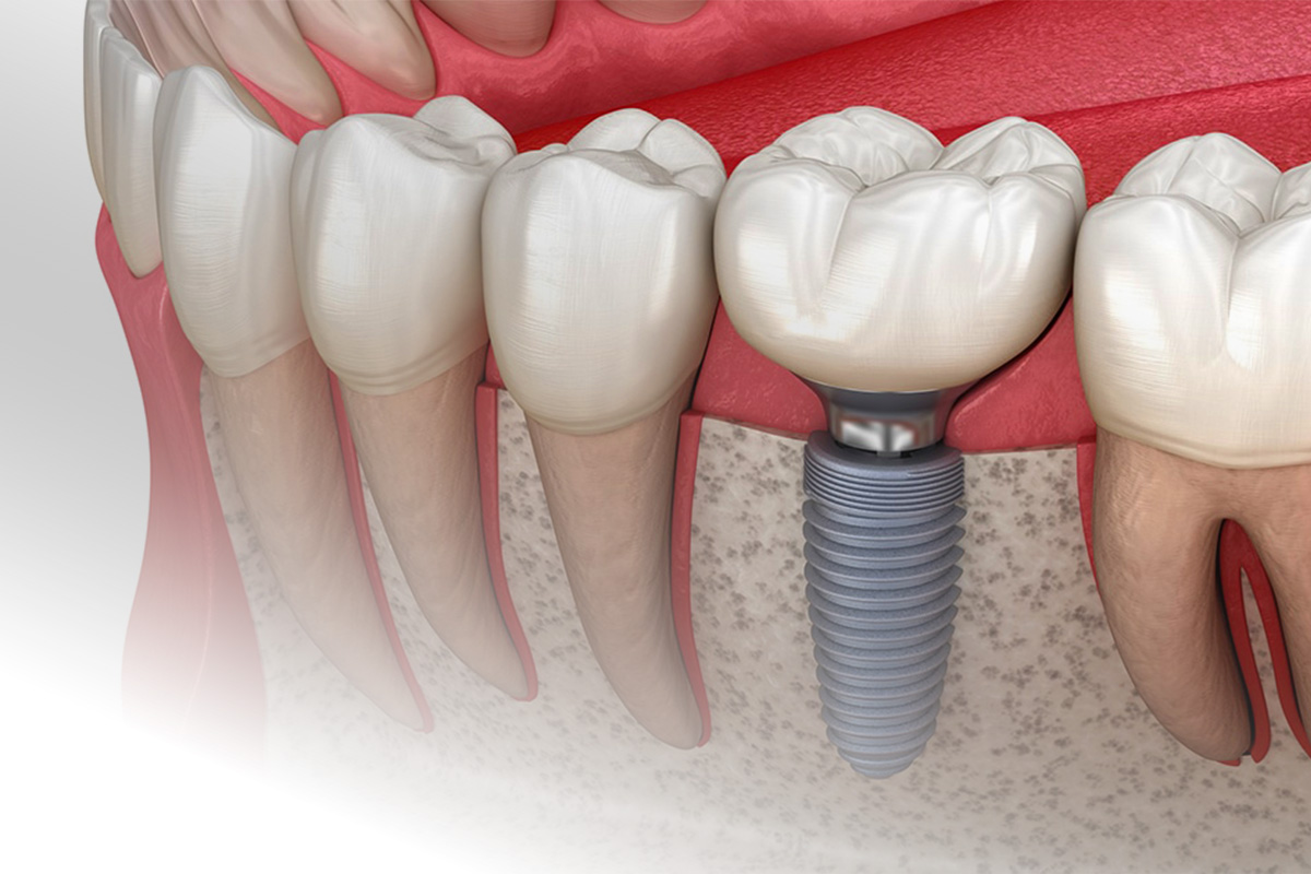 Single-tooth dental implant with zirconia crown integrated in the jawbone